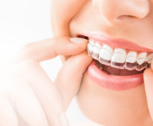 Invisalign Clear Aligners Sandbach Cheshire Consultations Now Open for Private Patients at Crown Bank Dental