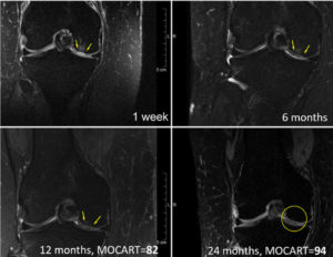 Regentis’ GelrinC Demonstrates Breakthrough in Regenerating Native-Like Cartilage Structure in Knee Repair on MRI Results Confirmed Using a Validated, Regulator-Accepted Method