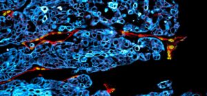 Aggressive oral cancer can be identified at an early stage by changes in lymphatic vessels