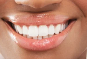 Composite Bonding Kidbrooke Cosmetic Dentist Dr Mori Shahid Recommends Treatments at Kidbrooke Village Dentist (Smile 4 U)