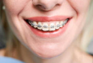 Growth in Demand for Dental Braces in Los Angeles Reported