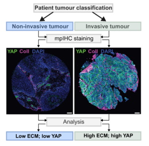 Researchers played music to cells – aggressiveness of laryngeal cancer decreased